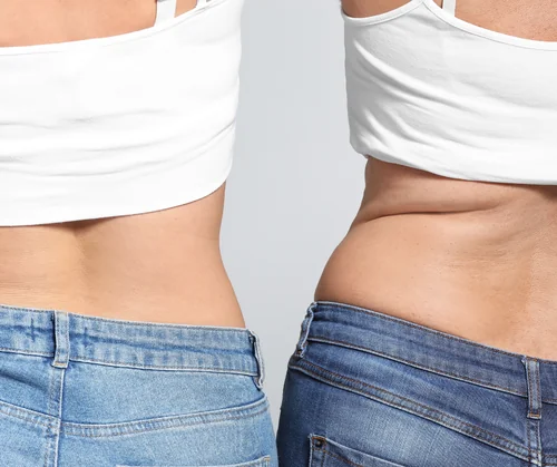 CoolSculpting love handles guide hero image