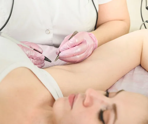 Does electrolysis hurt guide hero image