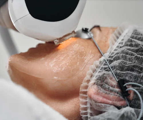 IPL photofacial benefits guide hero image