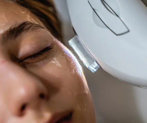 What is IPL photofacial guide hero image