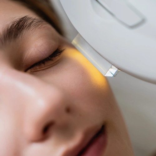 IPL photofacial inspiration