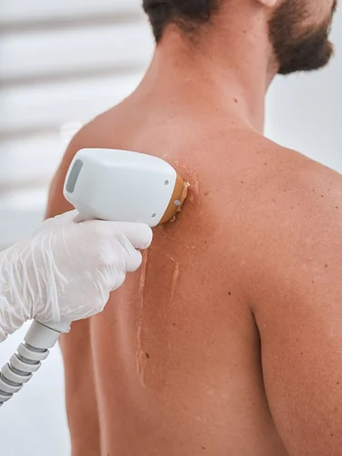 Laser hair removal for men hero image