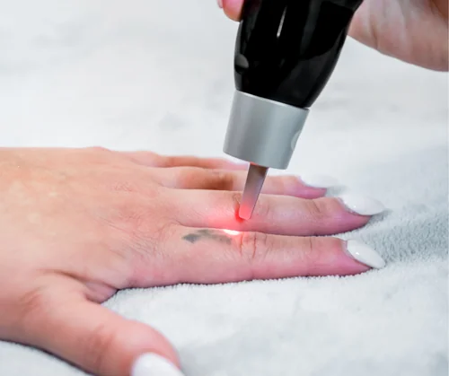 Laser tattoo removal aftercare guide hero image