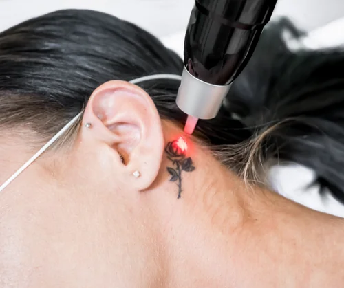 How much is laser tattoo removal guide hero image