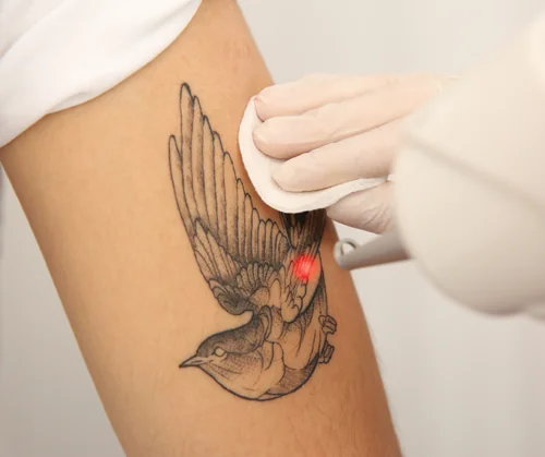 How does laser tattoo removal work guide hero image