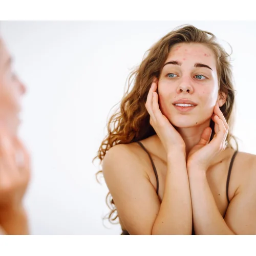 Microdermabrasion for acne guide hero image