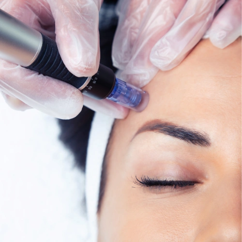 Microneedling inspiration